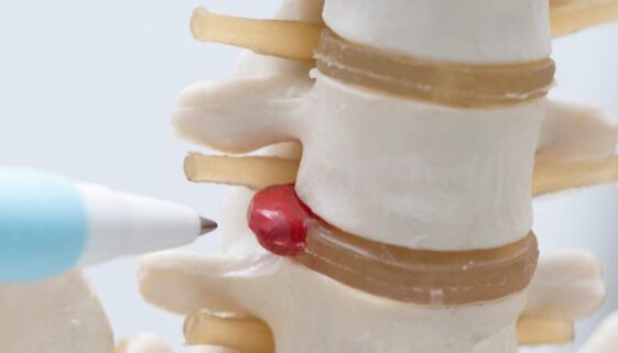 Tratamiento para mejorar la Hernia discal